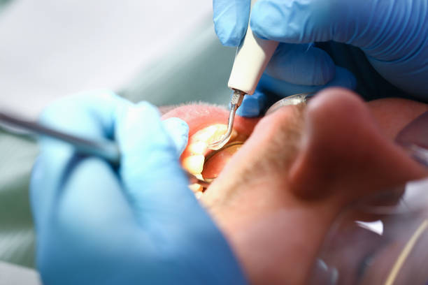 Best Emergency Root Canal Treatment in Logansport, IN